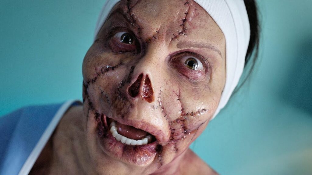 She Wanted Beauty, But the Plastic Surgeon Gave Her Three Breasts and a Stitched Face.