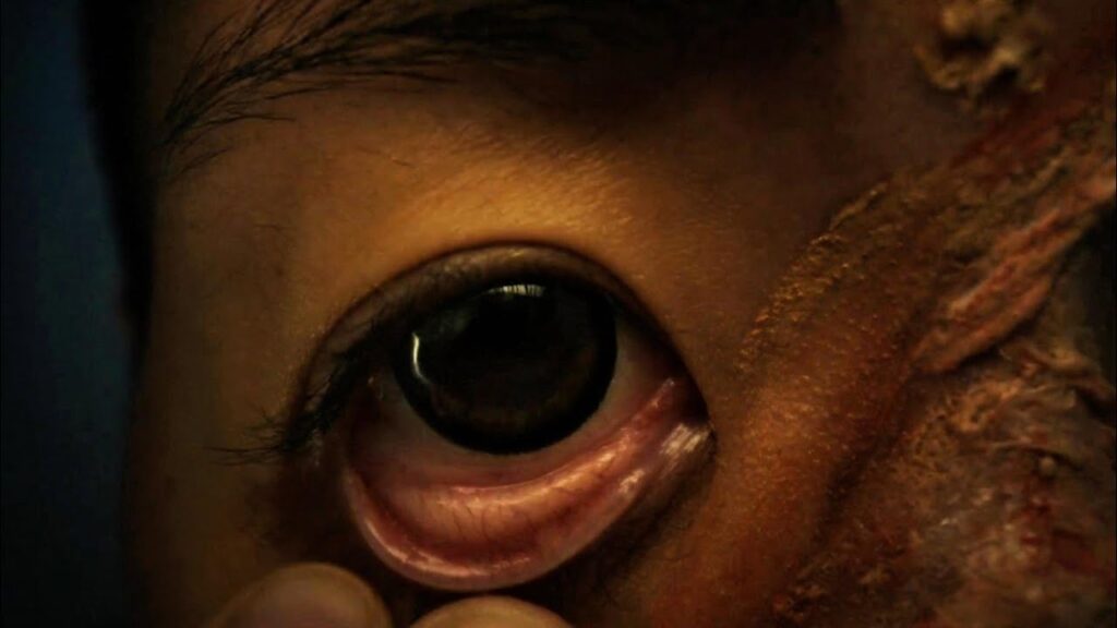 Doctor Finds Thousands Of Parasites Inside A Patients Pupils Crawling Out In The Sun